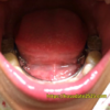 急速拡大装置2か月11日間の経過まとめ!下顎に舌側弧線装置が装着された!